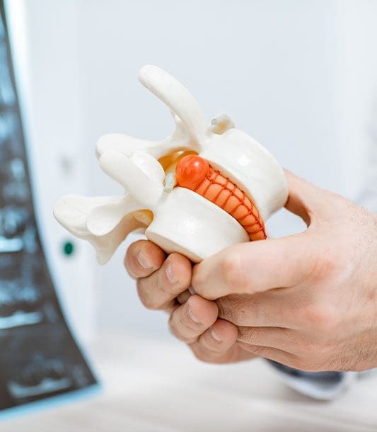 A model of a herniated disc.