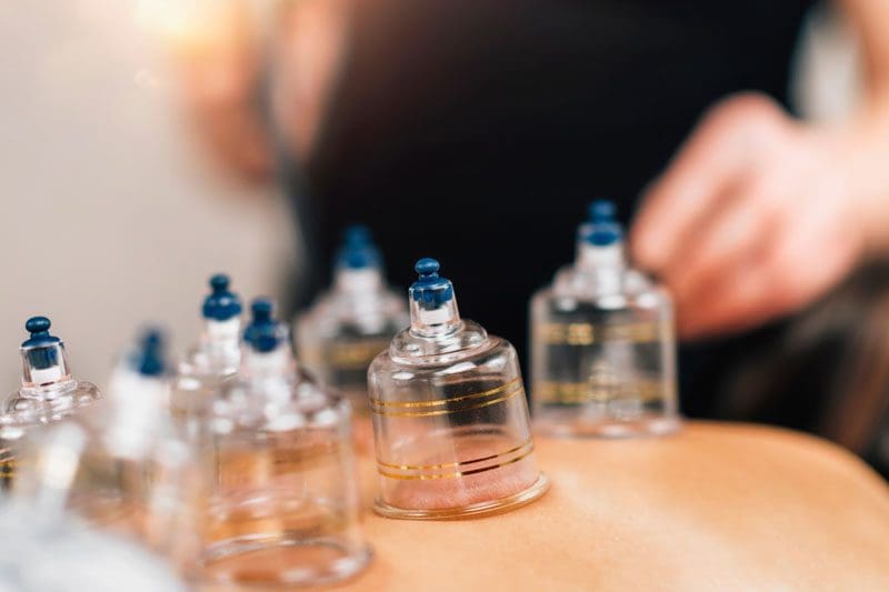 Cupping suction therapy on the back.