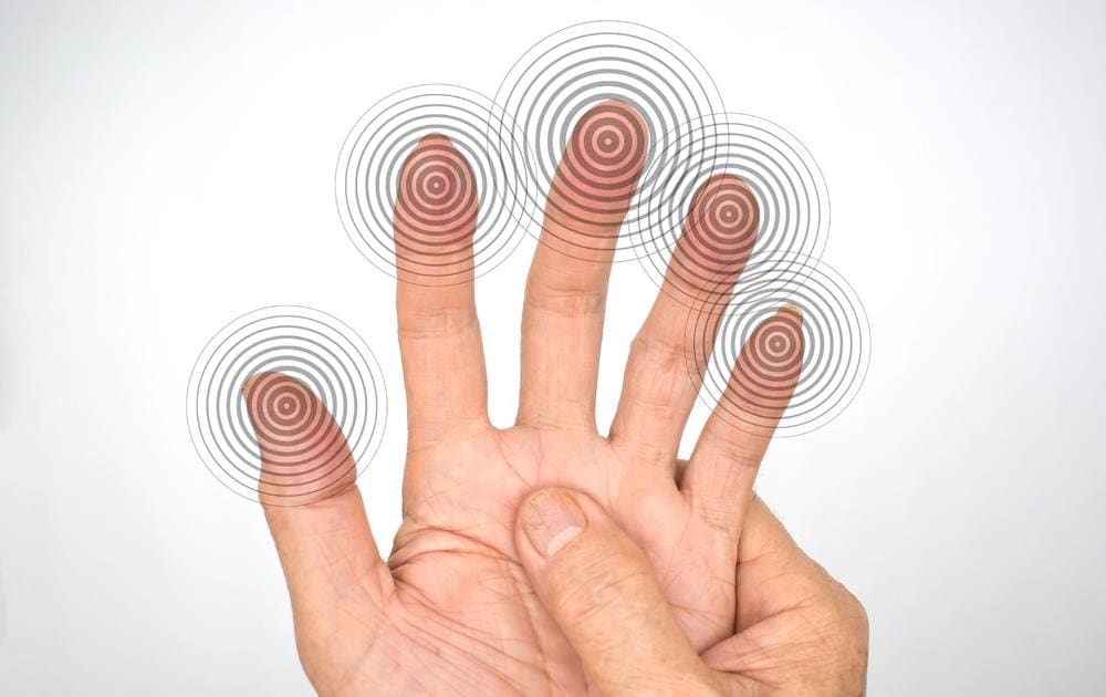 An artistic rendition demonstrating numbness in the hand.  