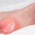 Treating Bone Spurs Naturally with Chiropractic Care
