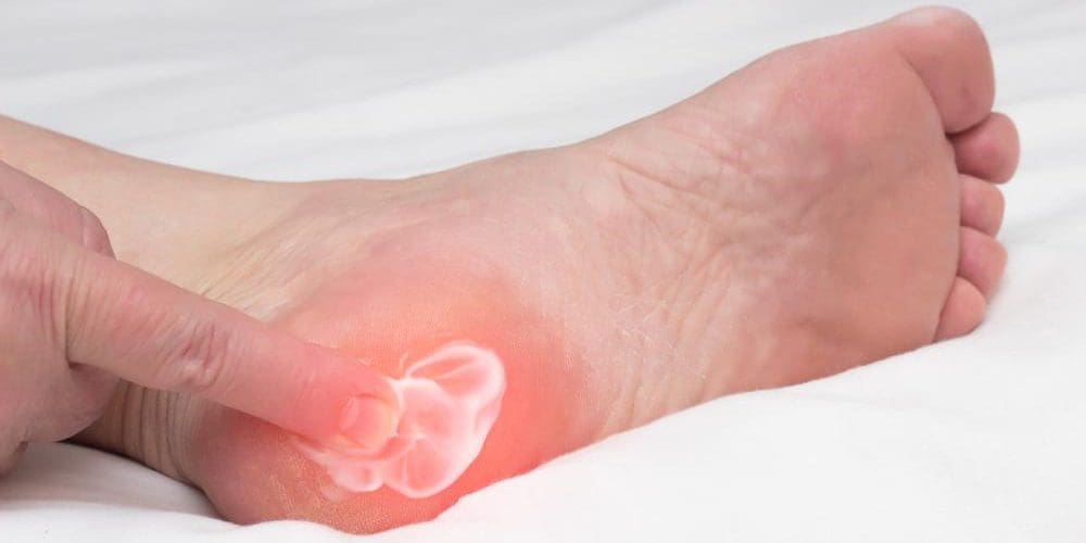 A man is pointing to a bone spur in his heel.