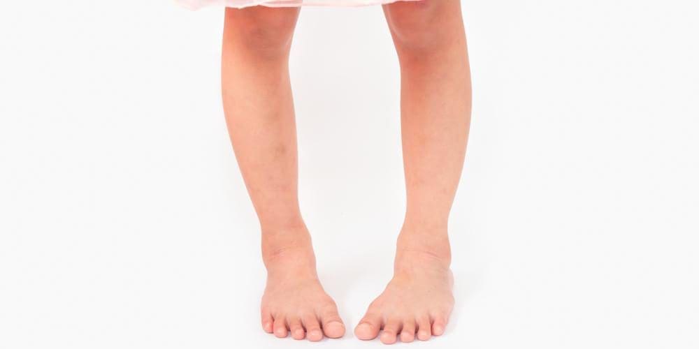A girl with bow legs.