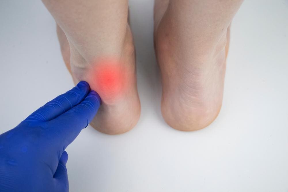 A man is being examined by a doctor for achilles tendonitis. 