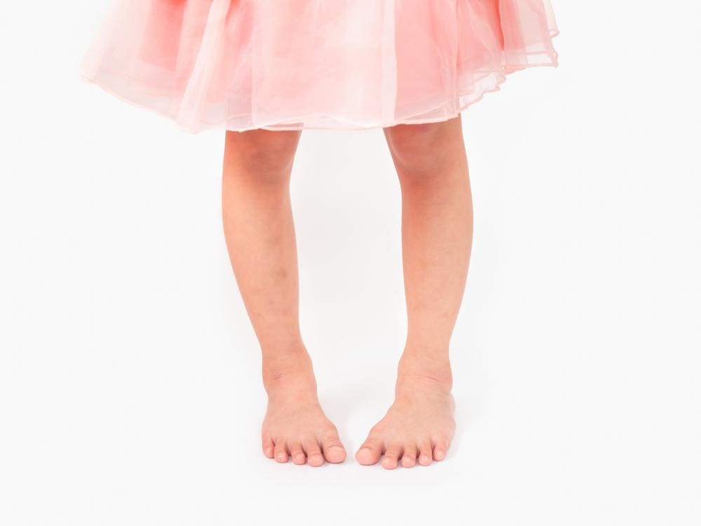 A young girl with femoral anteversion. 