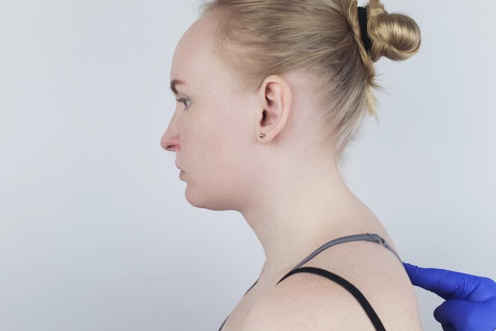 Young woman with neck hump.
