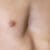 Chiropractic Care for Pectus Excavatum