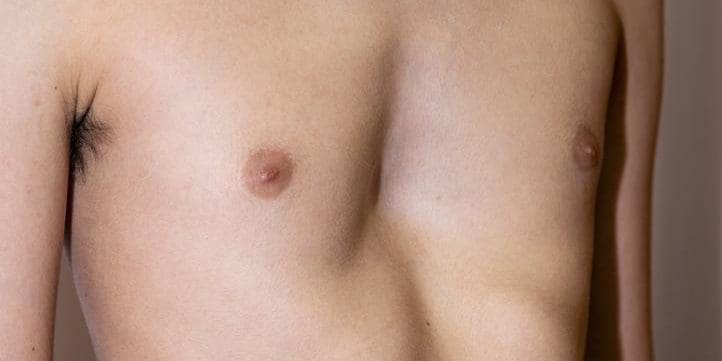 Male teenager with pigeon chest.