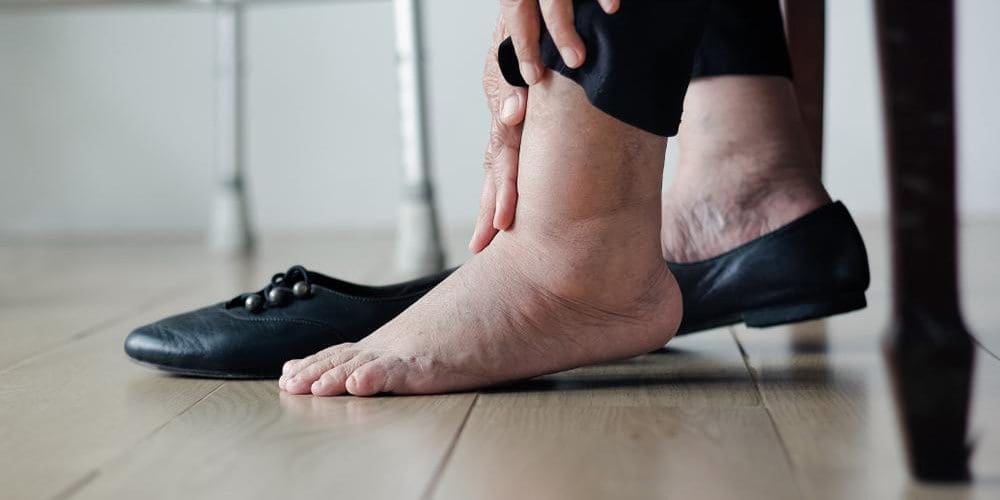 Closeup of an older woman's swollen feet due to Peroneal Tendonitis.