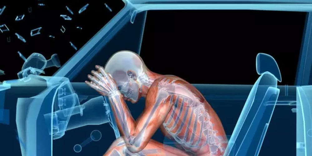 An artist's rendition of the impact of a car accident on the human body and spine.