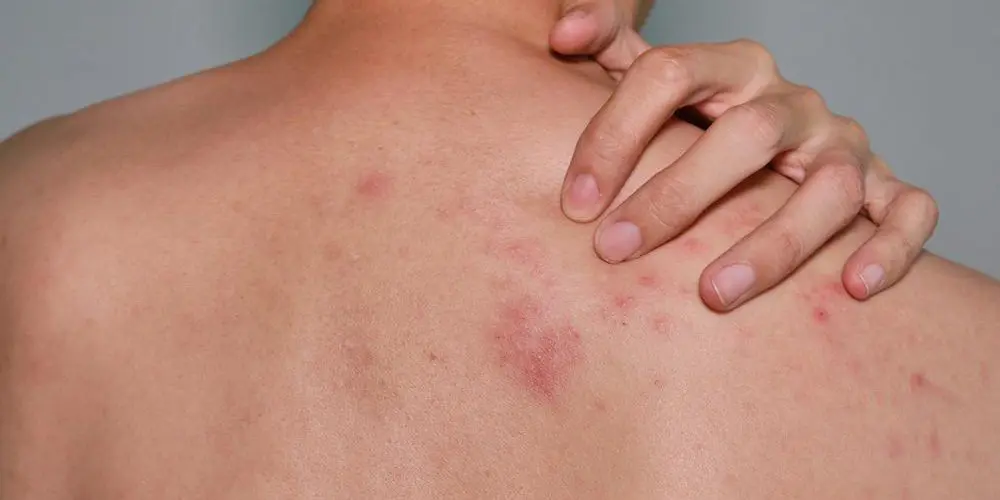 A man has a shingles rash on his back.